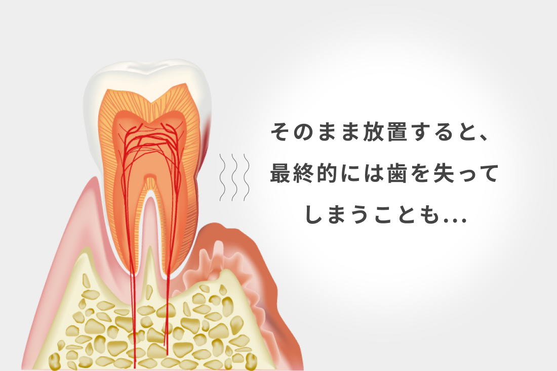 そのまま放置すると、最終的には歯を失ってしまうことも...