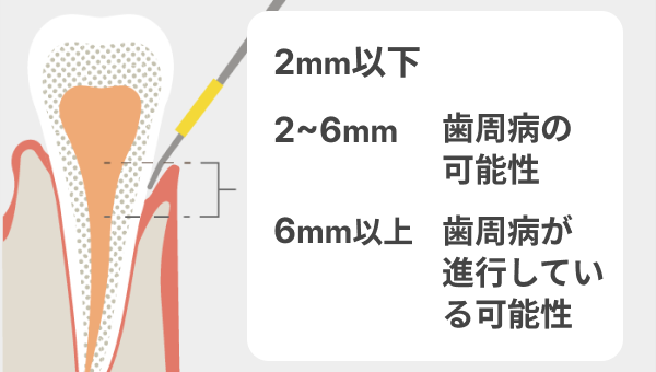 歯周ポケット検査
