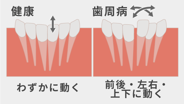 動揺度検査